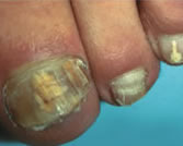 Более длительно существующее поражение ногтей. Проникновение грибка вглубь ногтя