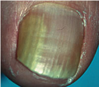Дистально-латеральная форма онихомикоза. Это фото типично для большинства случаев грибковых заболеваний ногтей